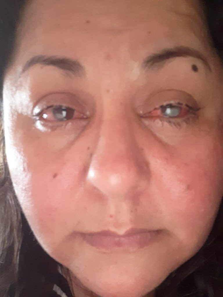 Com grave doença nos olhos, moradora de Rio Novo do Sul precisa de cirurgia com urgência 