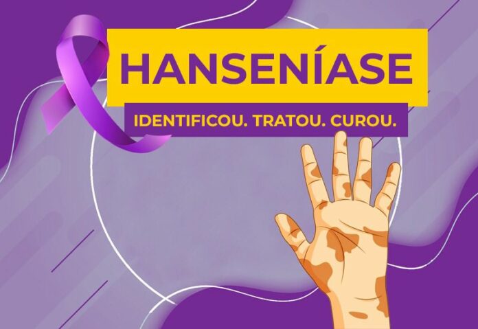 SAÚDE PROMOVE SEMANA ESPECIAL DE ATENDIMENTO PARA DIAGNÓSTICO DA HANSENÍASE