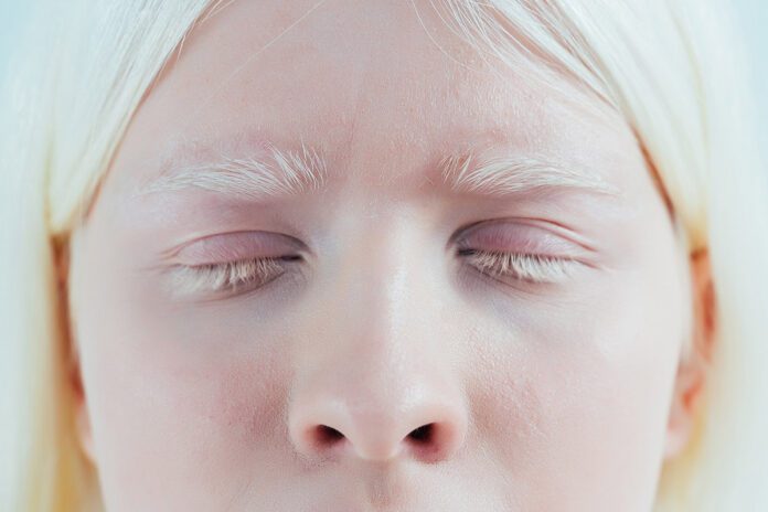 Matéria garante protetor solar para albinos
